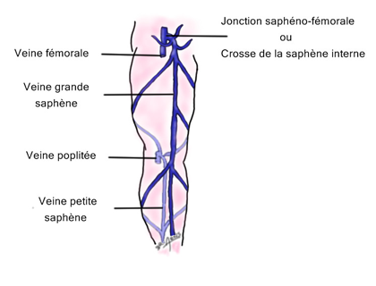 Les varices se développent à partir d'une seule vanne incompétente, le plus souvent à la jonction saphéno-fémorale ou crosse de la saphène interne