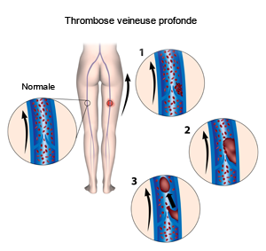 La thrombose veineuse profonde correspond à la formation d’un caillot de sang ou thrombus dans une veine des membres inférieurs.